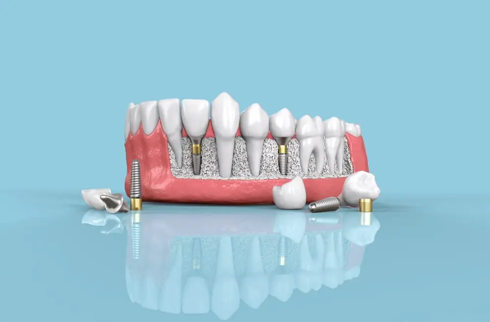 Osteointegracja — proces połączenia się implantu z kością